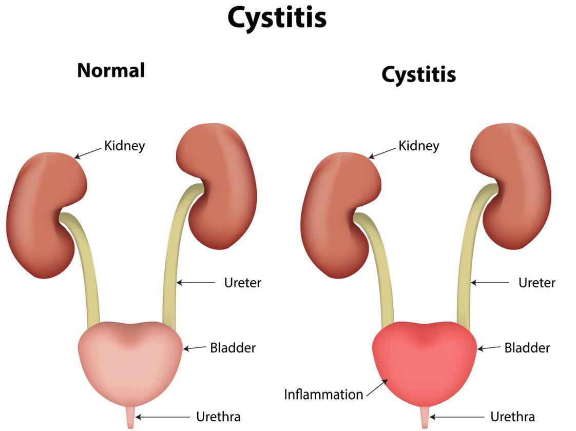 Cystitis Is An Inflammation Of The Bladder Usually Caused By An Ascending Organism Introduced Through