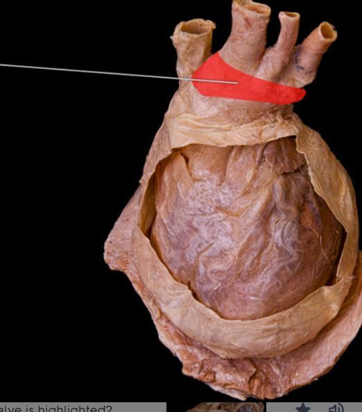 Identify The Highlighted Vessel. Identify The Highlighted Vessel. Aortic Arch Superior Vena Cava Brachiocephalic