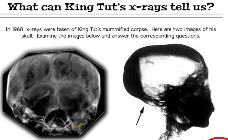 The X-ray On The Right Is Pointing Out An Area On The Back And Bottom Of Tut's Skull. The Large White