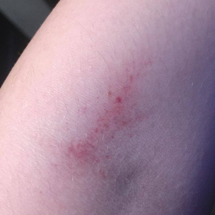 What Is This On My Arm? Im Concerned 